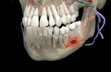 Dental abscess video from 3D Anatomy for Dental Hygiene from Primal Pictures