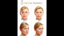 Dermal Fillers  - www.claesthetics.com