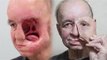 Amazing Technology - 3D Printing gives man a New FACE & New Life