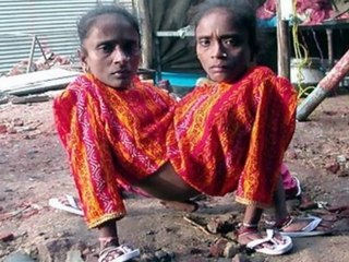OMG!!! Spider Girl (Conjoined Twins)