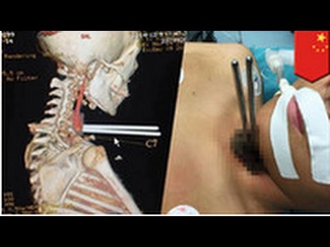 Accident: Un garçon se retrouve avec ses baguettes chinoises enfourchées dans la gorge