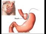 crohn_hastalıgı danışma 0535 3573503,crohn hastalığı tedavisi,crohn hastalığı bitkisel tedavi,kron crohn hastalığı nedir