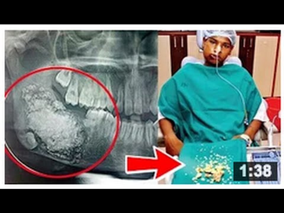 QUOI DE NEUF DOC: Un jeune se fait enlever 232 dents suite à un améloblastome dentifié