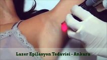 Lazer Epilasyon - Ankara