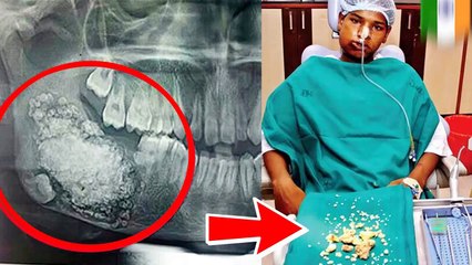 أشيك جافي أجرى عملية انتزع فيها الأطباء 232 سن من فمه