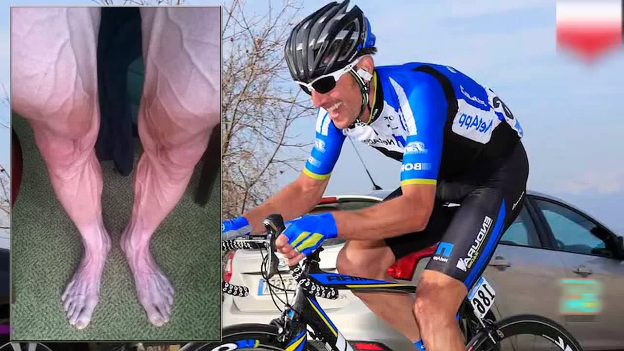 بارتوس هوزراسكي متهم بتعاطي المنشطات بسبب صورة وضعها على فيسبوك تظهر الشرايين بارزة من ساقه