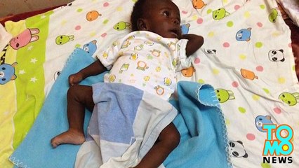 طفل رضيع يولد بثماني أطراف