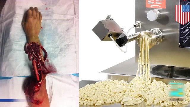 آلة صنع المعكرونة تقطع يد مراهق أثناء العمل