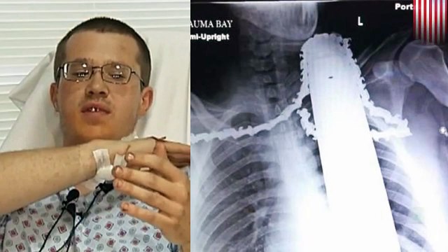 بستاني ينجو من الموت ذبحاً بمنشار الأشجار بعد أن غرزَ برقبتهِ