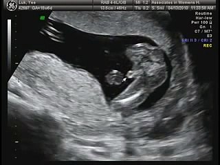 16 weeks Ultrasound - It's a Boy!!!