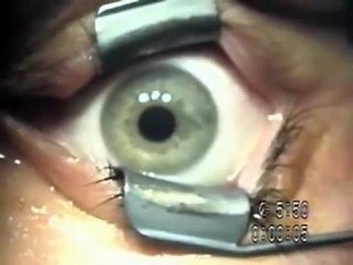 Lasek eye surgery video