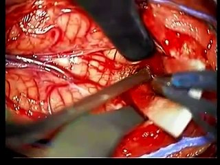 Pediatric Neurosurgery