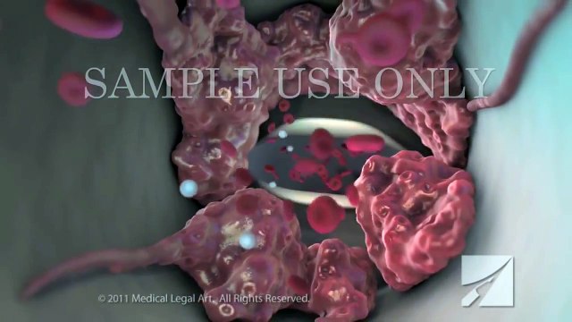 Deep Vein Thrombosis (DVT) and Pulmonary Embolism (PE)