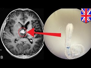 Hombre en el Reino Unido descubrió que tenia una solitaria viviendo en su cerebro