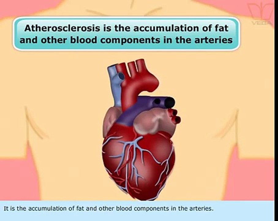 Atherosclerosis CBSE-12 biology
