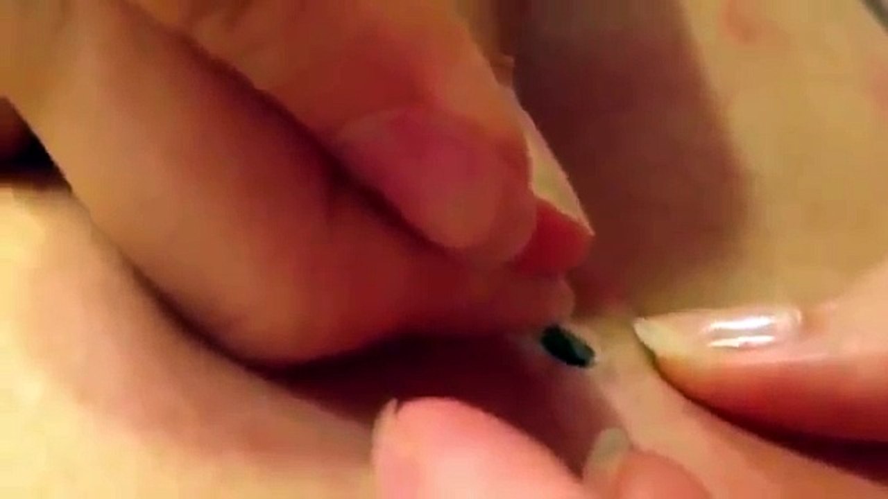 Blackhead Removal SHOCKING Video