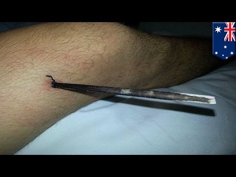 Joven sobrevive al ataque de una raya venenosa en Australia al recordar la muerte de Steve Irwin