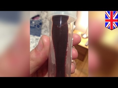 Sanguijuela vivió escondida en la nariz de una mujer británica por mas de un mes