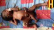 Bebe en Uganda que nació con 4 brazos y 4 piernas es sometido a cirugía para remover gemelo parasito