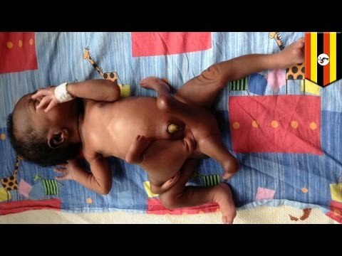 Bebe en Uganda que nació con 4 brazos y 4 piernas es sometido a cirugía para remover gemelo parasito