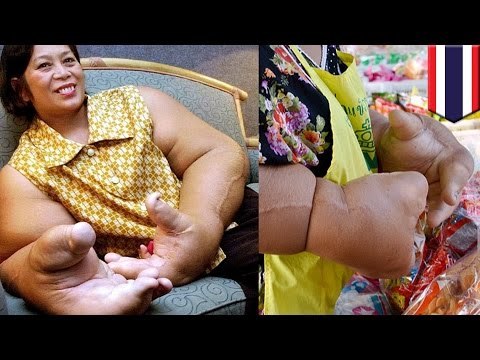 Extrañas enfermedades: Mujer tailandesa tiene el record de las manos mas grandes del mundo