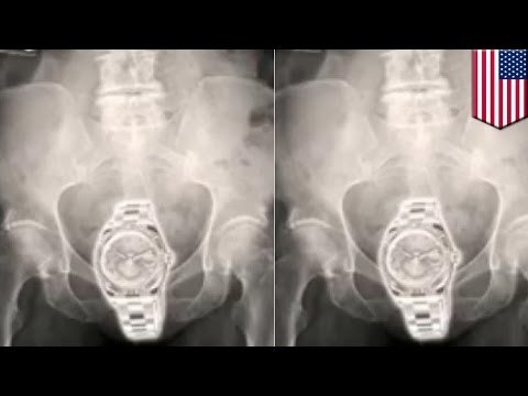 Mujeres atrapadas al intentar ocultar un Rolex robado en sus vaginas