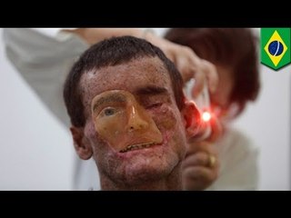 Extraña enfermedad de la piel afecta a un pueblo en Brasil