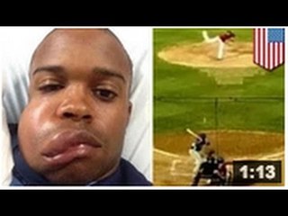 Le visage de Delino DeShields Jr. des Astros de Houston  a enflé