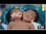 Les deux bébés sœurs siamoises sont mortes après trois semaines