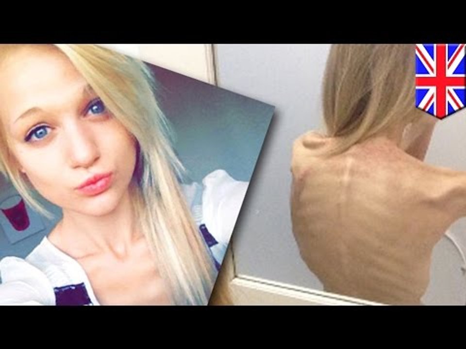 Eating disorders: Pro-ana websites and thinspiration photos almost killed this teen