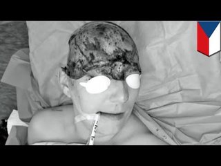 Freak accident: Woman's head scalped by electric drill in notifying mishap