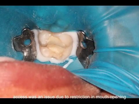 Root canal treatment in a severe tooth abscess