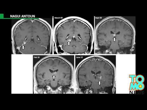 Pasożyt przez 4 lata przegryzał się przez mózg mężczyzny
