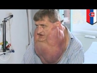 Slovakian na lalake, nagpatanggal ng 6-kilo tumor mula sa kanyang mukha at leeg!
