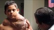 Giant tumor removed: Mexican boy takes Viagra to shrink neck tumor prior to surgery