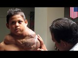 Giant tumor removed: Mexican boy takes Viagra to shrink neck tumor prior to surgery