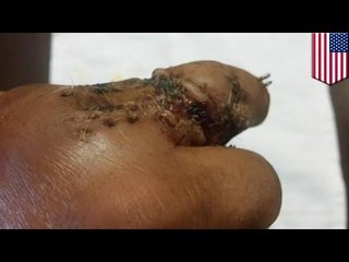 Jose Canseco says finger fell off during poker tournament, posts graphic and very gross photos