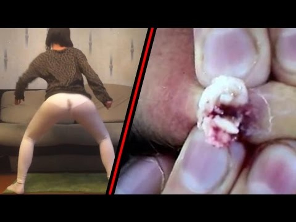 Russian twerk shart FAIL, 20-year-old pimple po...