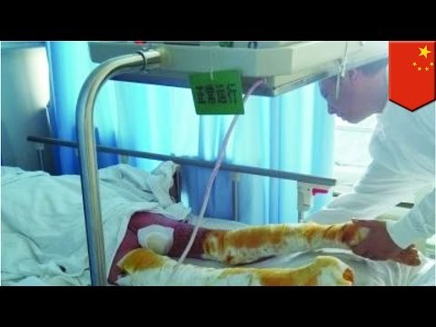 Dumb accident: Pre-teen nearly burned alive after father uses GASOLINE to heal her burn wounds