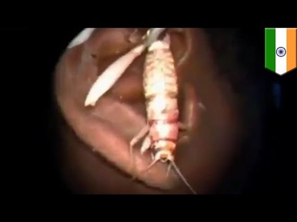 Bug in ear: Indian guy has kraken pulled out of his ear by doctor