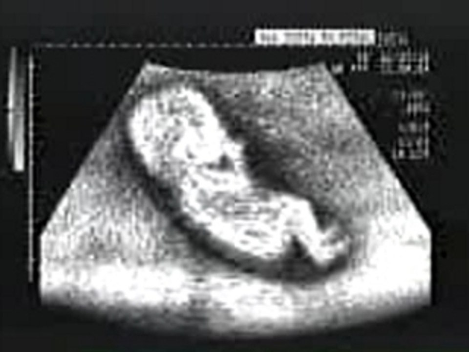 Echographie... C'est un garçon !