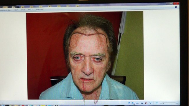 Excellent Man Hair Loss Transplant Surgery Result Before After Photos Dr. Diep mhtaclinic.com