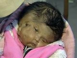 Baby born with two faces, four eyes, two noses, two mouths