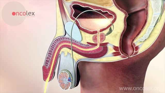 nguyên nhân ung thư tuyến tiền liệt
