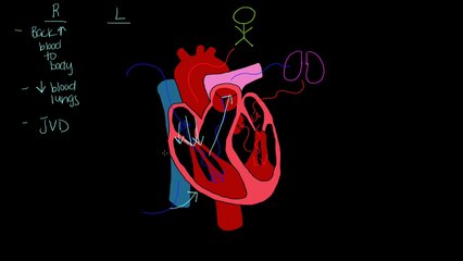 Left sided vs. Right sided heart failure