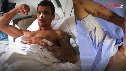 L'état du bras de Mandzukic après la morsure de Carvajal !