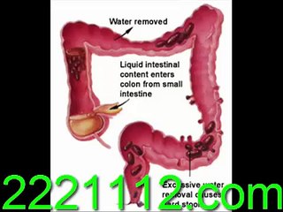 CHRONIC CONSTIPATION - اردو