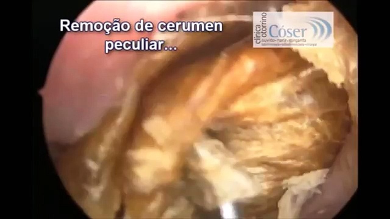 【閲覧注意】衝撃！ヤバすぎる　耳糞（耳垢）除去（掃除）超ｽｯｷﾘ 衝撃映像　総集編VOL.1 【ｸﾞﾛ注意】