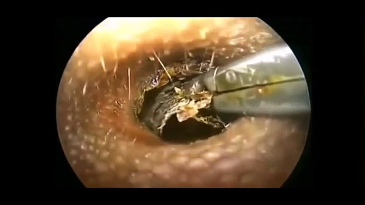 【閲覧注意】衝撃！ヤバすぎる　耳糞（耳垢）除去（掃除）超ｽｯｷﾘ衝撃映像　総集編VOL.2 【ｸﾞﾛ注意】