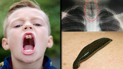 LEECH Found Growing In Boy's Throat | Eewww!!